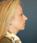 Feel Beautiful - Face Lift San Diego 50 - Before Photo